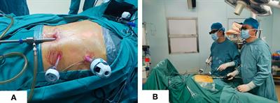 Initial experience with triple port laparoscopic distal gastrectomy